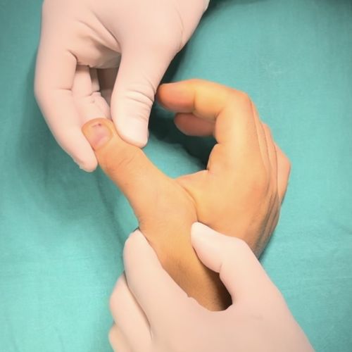 Kayakçı Başparmağı ( Ulnar Kollateral Bağ Yaralanması)