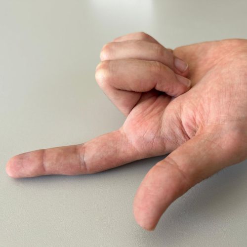 Fleksor tendon yaralanmaları