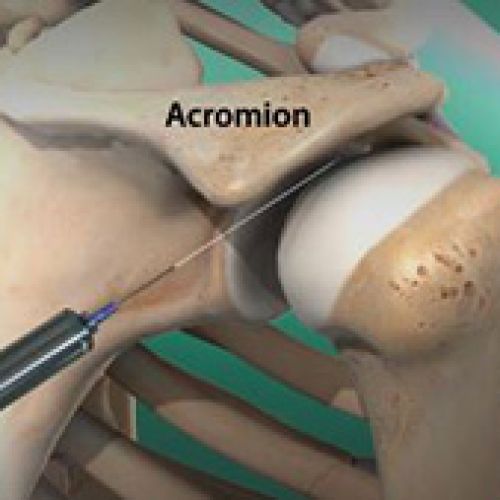 Omuz sıkışma sendromu (Impingement) nedir?