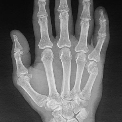 Boksör kırığı nedir ? ( 5.metakarp distal uç kırığı)