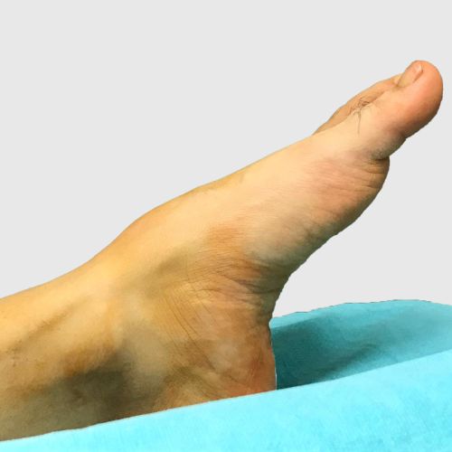 Düşük ayak nedir?