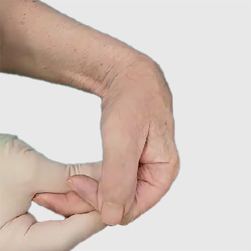 Felç ve Spastisite tedavisi -Hiperselektif Nörektomi