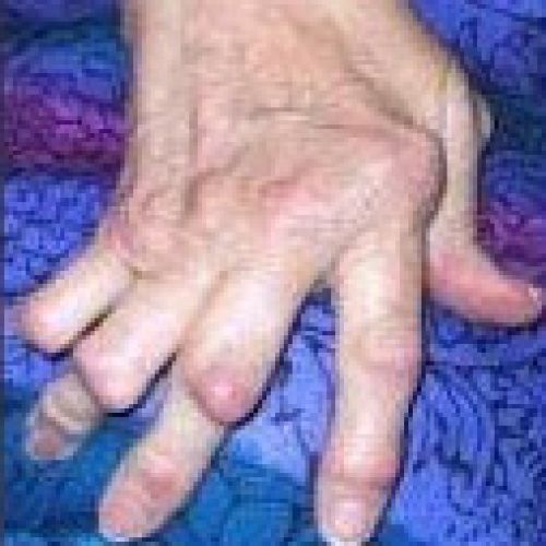 ROMATOİD ARTRİT