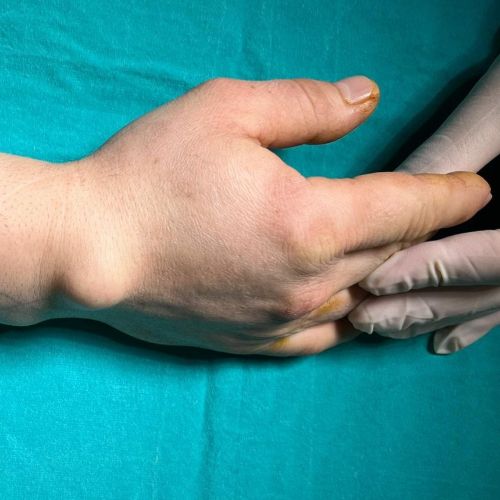 Ganglion kisti