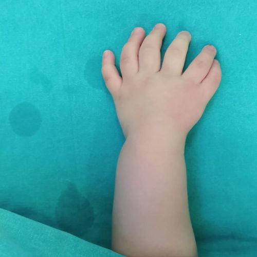 Polidaktili
