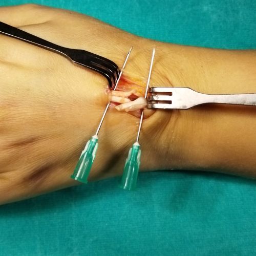 Ekstensör tendon yaralanmaları