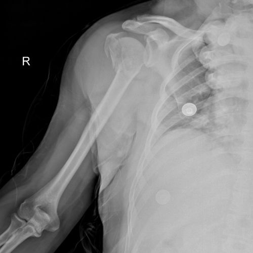 Omuz kırığı (Proksimal Humerus Kırıkları)